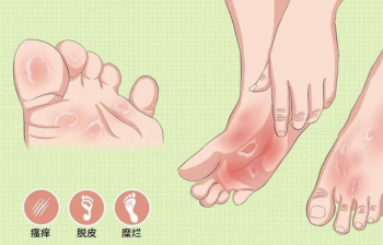 脚趾起水泡怎么办